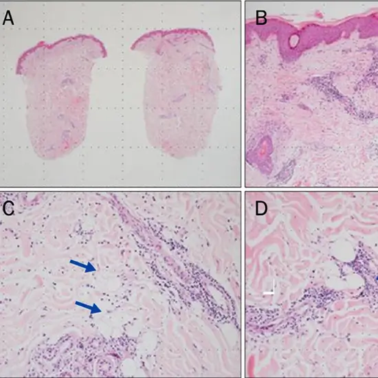 Histopathology Biopsy: Small Specimen Test